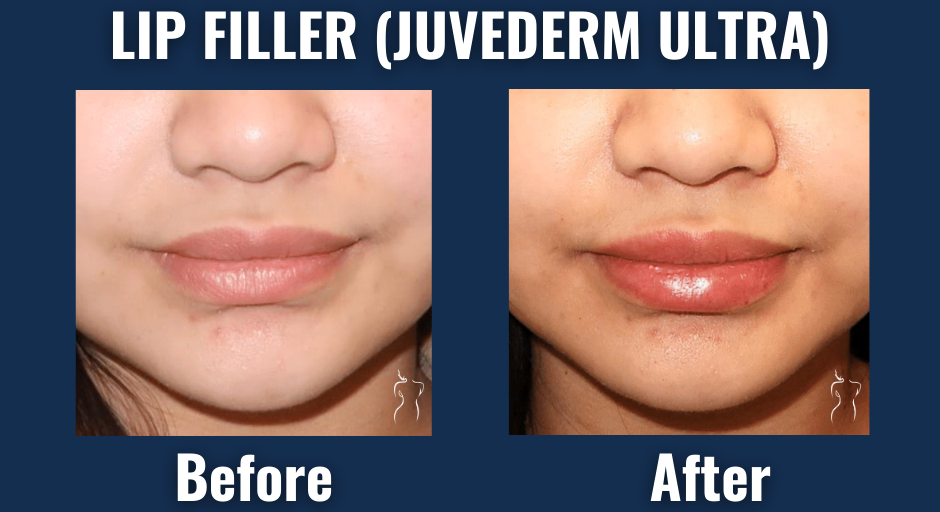 Before and after photos of juvederm ultra lip filler treatment showing natural-looking fuller lips and improved lip shape.