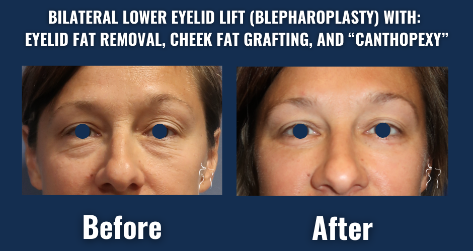 Before and after image showing lower eyelid lift with fat removal, cheek fat grafting, and canthopexy to reduce eye bags and smooth the under-eye region.