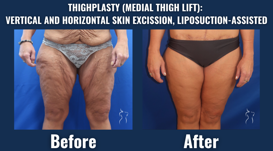 Before and after image showing thighplasty with vertical and horizontal skin excision and liposuction-assisted contouring.