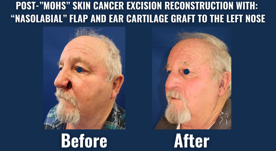 Before and after comparison of left nasal reconstruction after mohs surgery, featuring a nasolabial flap and ear cartilage graft to restore natural nasal contour.