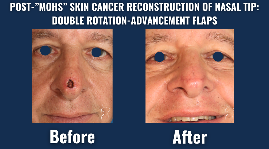 Before and after images of a male patient showing nasal tip skin cancer reconstruction using double rotation-advancement flaps after mohs surgery.