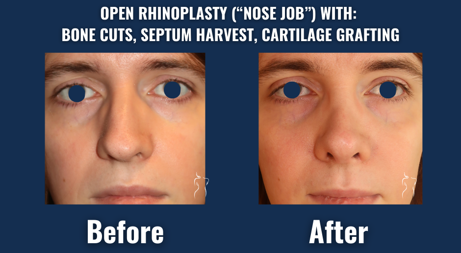 Close-up before and after results of open rhinoplasty with nasal bone cuts, septum tissue harvesting, and cartilage grafting for nasal reshaping.
