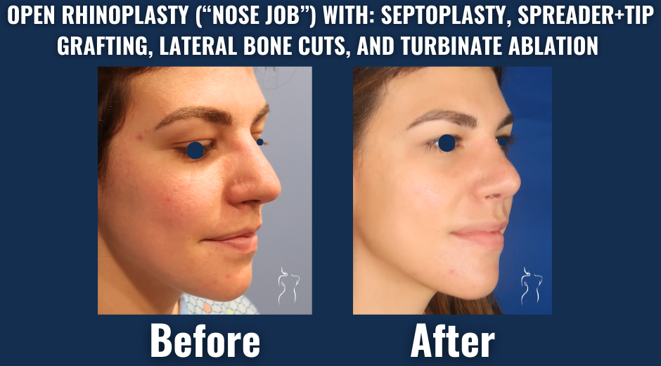 Side-by-side before and after photo showing rhinoplasty with septoplasty, spreader and tip grafting, and turbinate ablation for nasal profile enhancement.