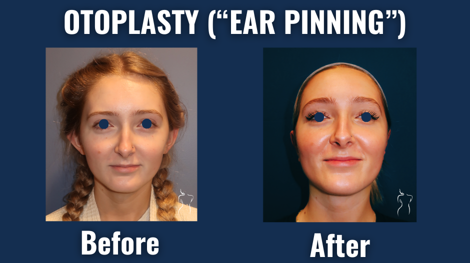 Front-facing before and after comparison of otoplasty (ear pinning) showing reduced ear projection and improved symmetry.