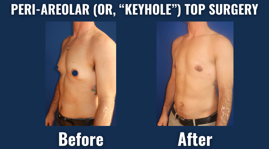 Before/after comparison of peri-areolar (keyhole) top surgery, demonstrating a masculinized chest with circular scars around the nipples and natural-looking contours.