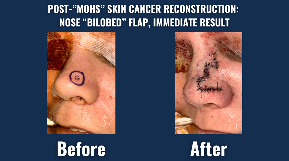 Before and after images of nasal skin cancer reconstruction using a bilobed flap immediately following mohs surgery, showing marked defect and sutured repair.