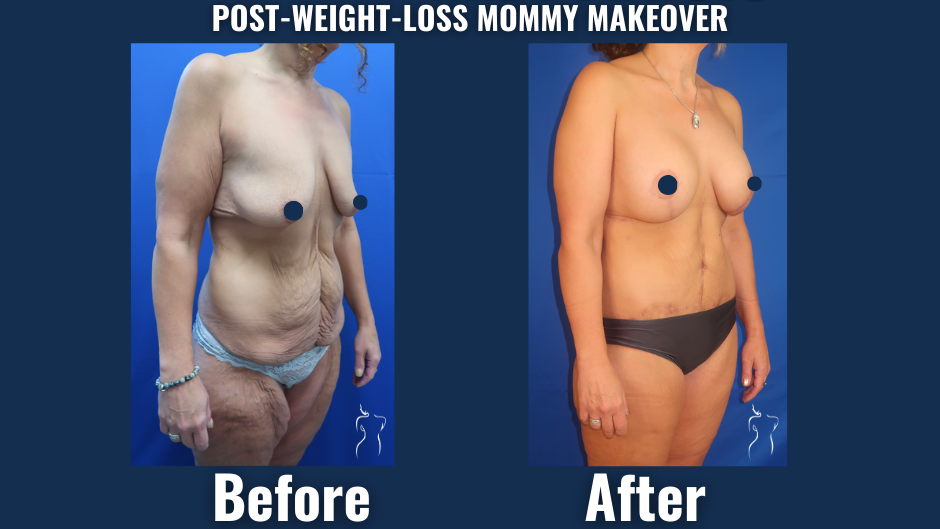 Before and after image showing post-weight-loss mommy makeover with breast enhancement and abdominal contouring.