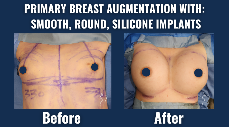 Before and after comparison of primary breast augmentation with smooth, round silicone implants, demonstrating increased breast volume and natural contour.