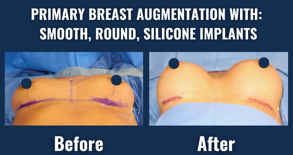 Visual comparison showing before and after results of primary breast augmentation with smooth, round silicone implants, highlighting improved breast volume and natural-looking enhancement.