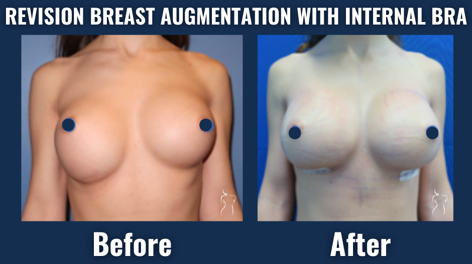 Before and after results of revision breast augmentation with internal bra support showing improved breast symmetry and implant stability.