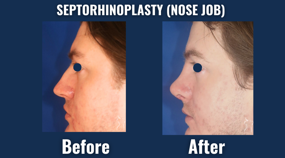 Visual comparison of septorhinoplasty results showing improved nasal structure and facial balance, with natural-looking surgical outcomes
