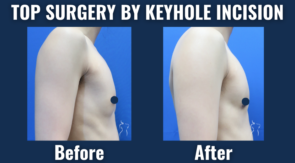 Before and after photos of top surgery using keyhole incision technique showing subtle, scar-minimized chest masculinization in an ftm patient.