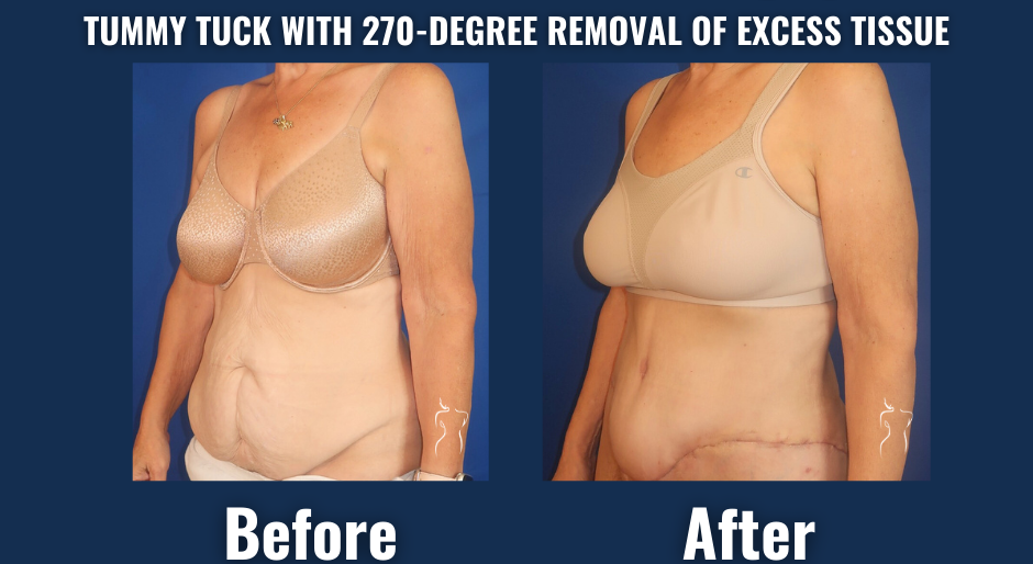 Visual comparison demonstrating transformative results of a 270-degree tummy tuck procedure with comprehensive tissue removal, revealing improved abdominal tightness and waistline contour.