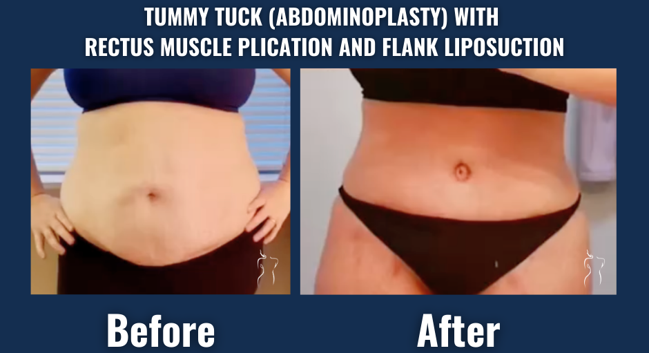 Visual comparison of a patient before and after tummy tuck surgery with rectus muscle repair and flank liposuction, demonstrating improved abdominal contour and waist definition.