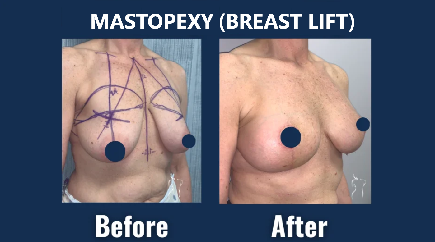 Before and after photos of a female patient following a mastopexy (breast lift) procedure.